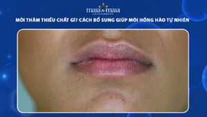 môi thâm thiếu chất gì