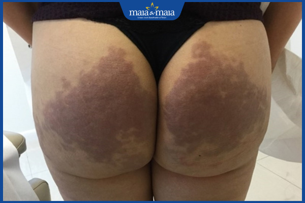 mông bị thâm đen