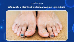 móng chân bị bầm tím