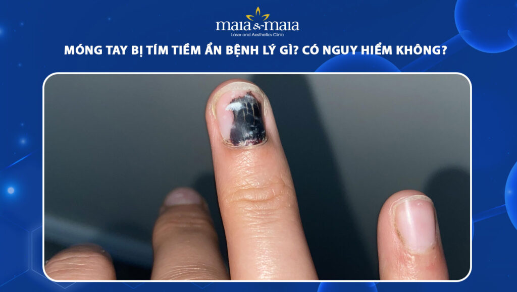 móng tay bị tím