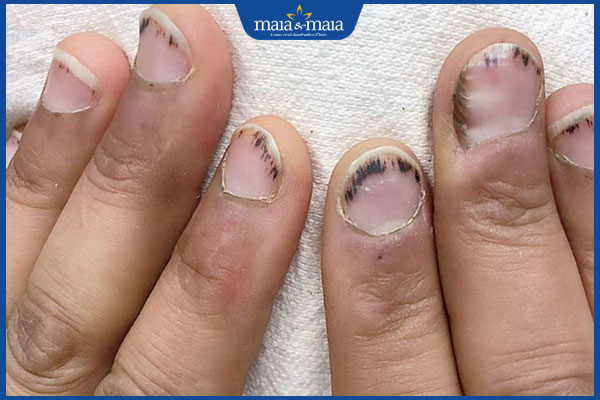 móng tay bị tím nhiều ngón