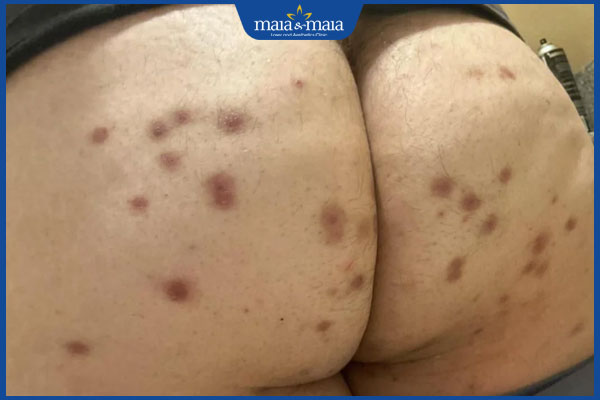 TOP 7 địa chỉ trị thâm mông uy tín hiện nay tại Hà Nội 2 mông thâm sạm