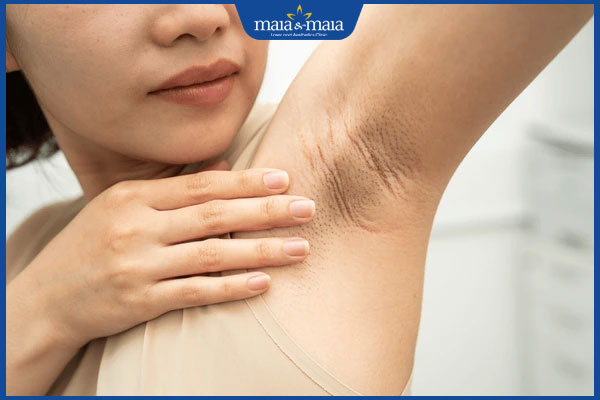 Thâm nách: Nguyên nhân, cách khắc phục và phòng ngừa hiệu 2 nách bị thâm