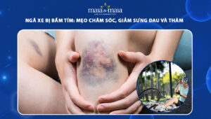 ngã xe bị bầm tím