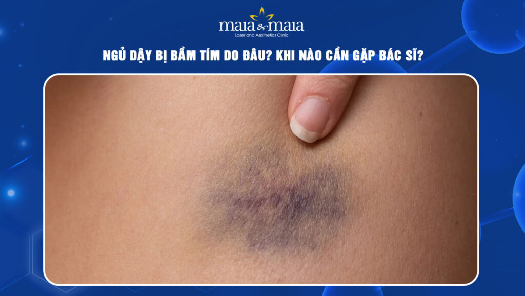 Ngủ dậy bị bầm tím do đâu? Khi nào cần gặp bác sĩ? 1 ngủ dậy bị bầm tím