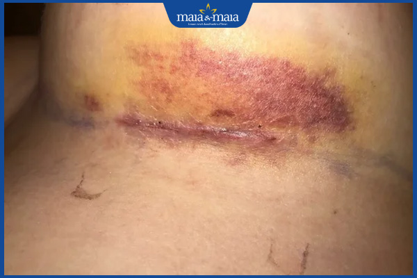 phẫu thuật bị bầm tím