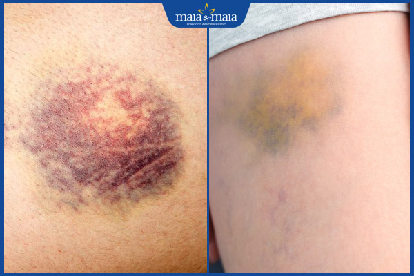 Vết bầm tím bao lâu thì hết? Biện pháp làm vết bầm nhanh tan 2 quá trình hết bầm