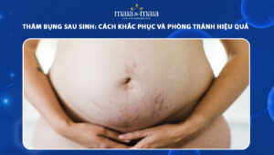 thâm bụng sau sinh