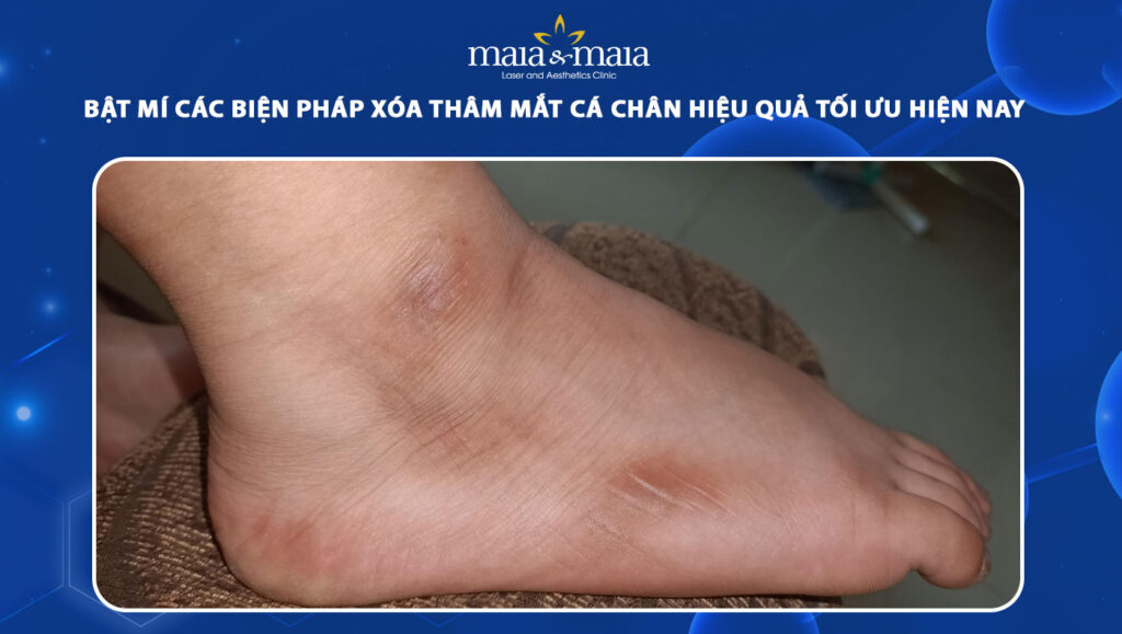 Bật mí các biện pháp xóa thâm mắt cá chân hiệu quả tối ưu hiện nay 1 thâm mắt cá chân