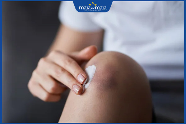 thoa kem vết bầm