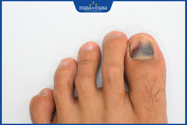 Móng chân bị bầm tím do đâu? Có nguy hiểm không? 2 tím móng chân