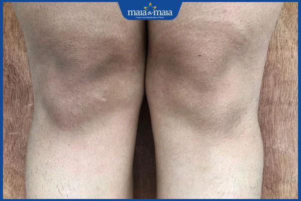 Con gái đầu gối thâm do đâu? Làm sao để khắc phục hiệu quả? 2 tình trạng đầu gối thâm