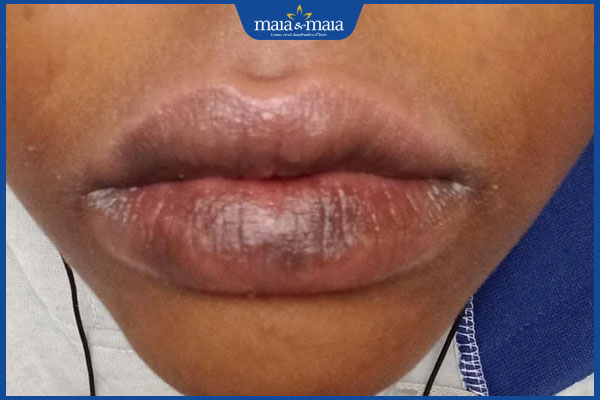 Môi thâm loang là bị sao? Cách lấy lại đôi môi sáng khỏe 2 tình trạng môi thâm loang lổ