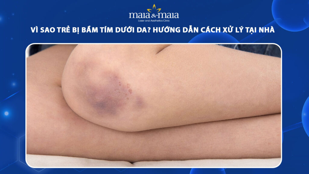 trẻ bị bầm tím dưới da