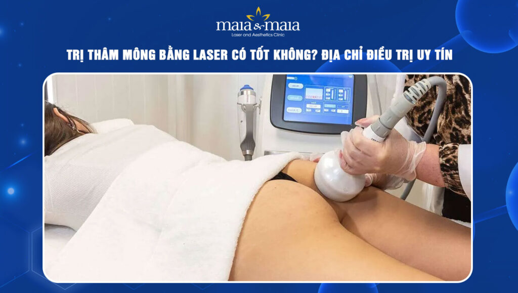 Trị thâm mông bằng laser