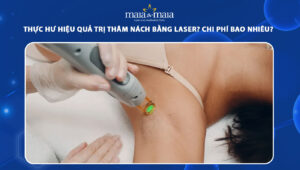 trị thâm nách bằng laser