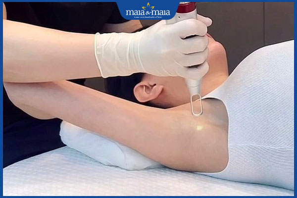 Trị thâm nách bằng laser tốt không? Chi phí bao nhiêu? 3 trị thâm nách bằng tia laser