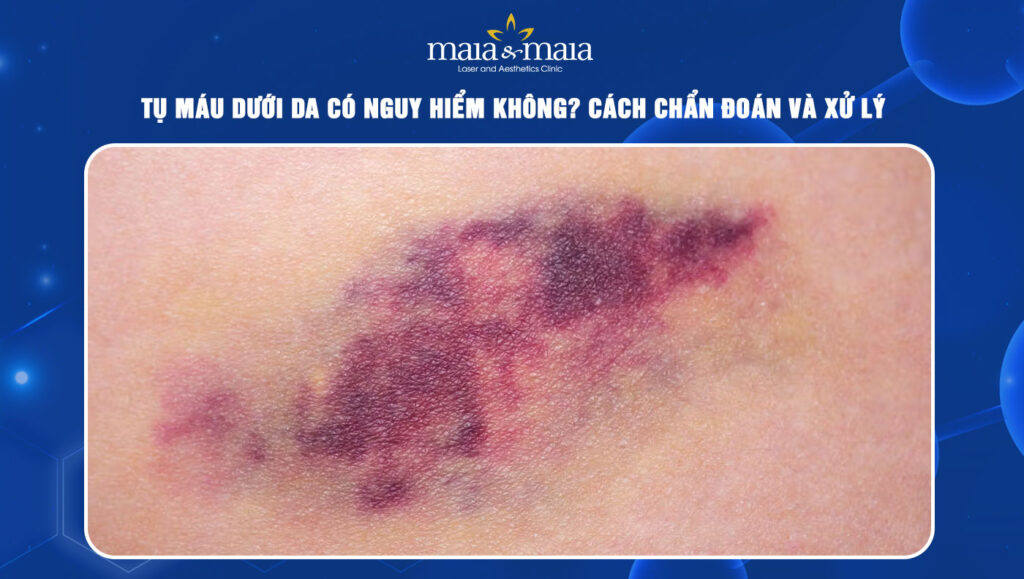 Tụ máu dưới da