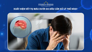 tụ máu dưới da đầu