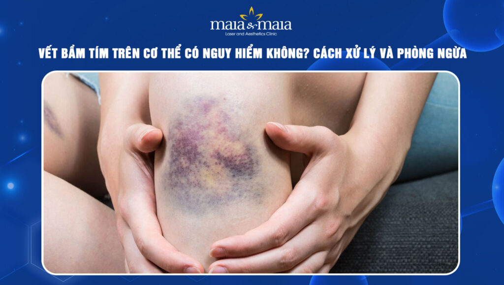 Vết bầm tím có nguy hiểm không? Cách xử lý và phòng ngừa 1 Vết bầm tím
