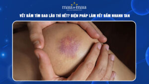 vết bầm tím bao lâu thì hết