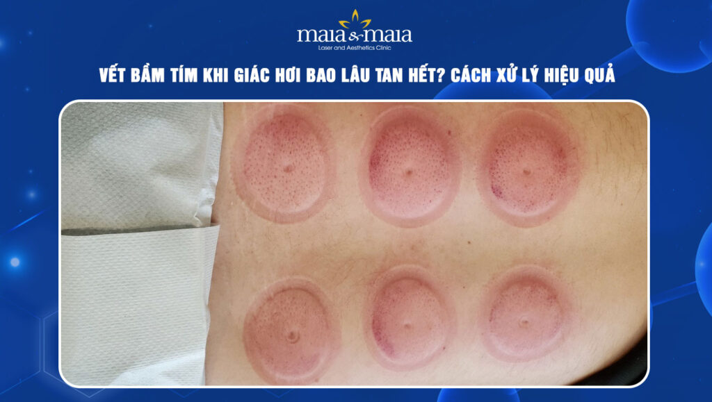 Vết bầm tím khi giác hơi bao lâu tan? Cách xử lý hiệu quả 1 vết bầm tím khi giác hơi