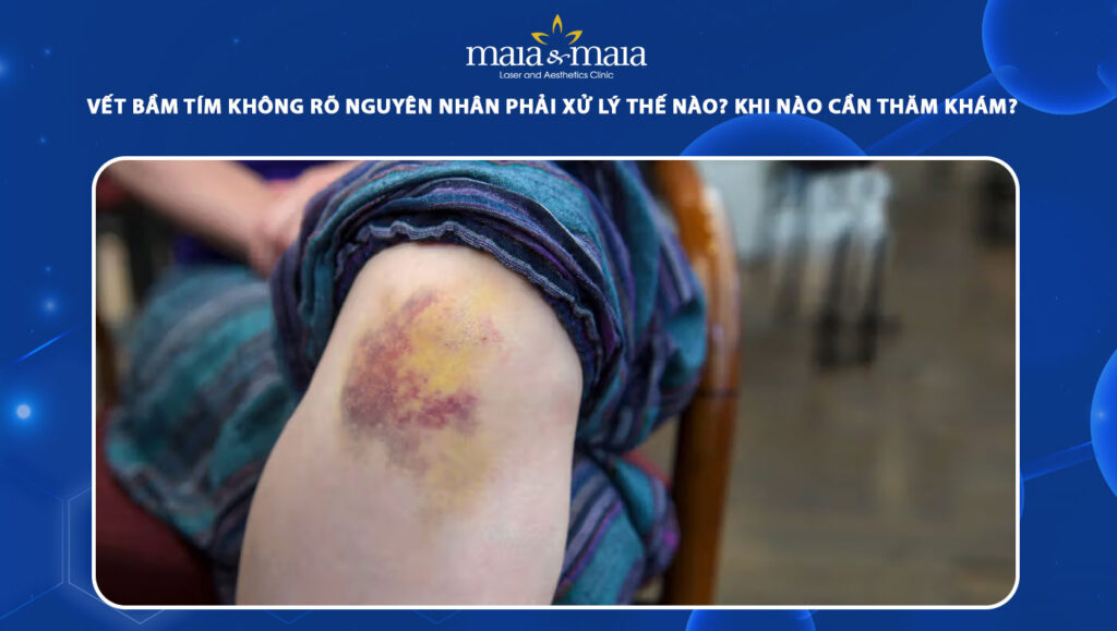 vết bầm tím không rõ nguyên nhân