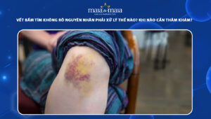 vết bầm tím không rõ nguyên nhân
