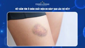 vết bầm tím ở chân