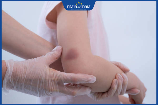 vết bầm tím ở tay trẻ