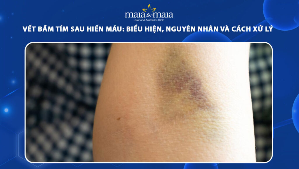 vết bầm tím sau hiến máu