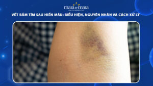 vết bầm tím sau hiến máu