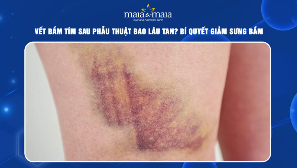 Vết bầm tím sau phẫu thuật
