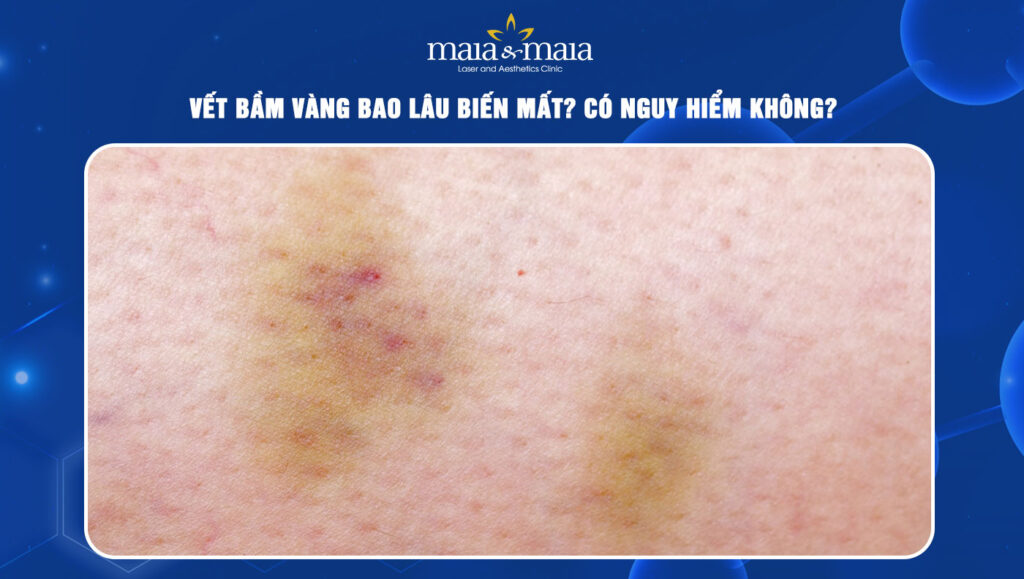 vết bầm vàng