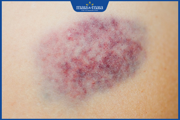 Vết bầm tím có nguy hiểm không? Cách xử lý và phòng ngừa 2 Vết bầm