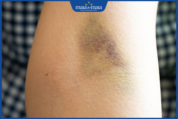 Vết tiêm bị bầm tím do đâu? Làm sao để vết bầm tan nhanh? 2 vết tiêm bầm