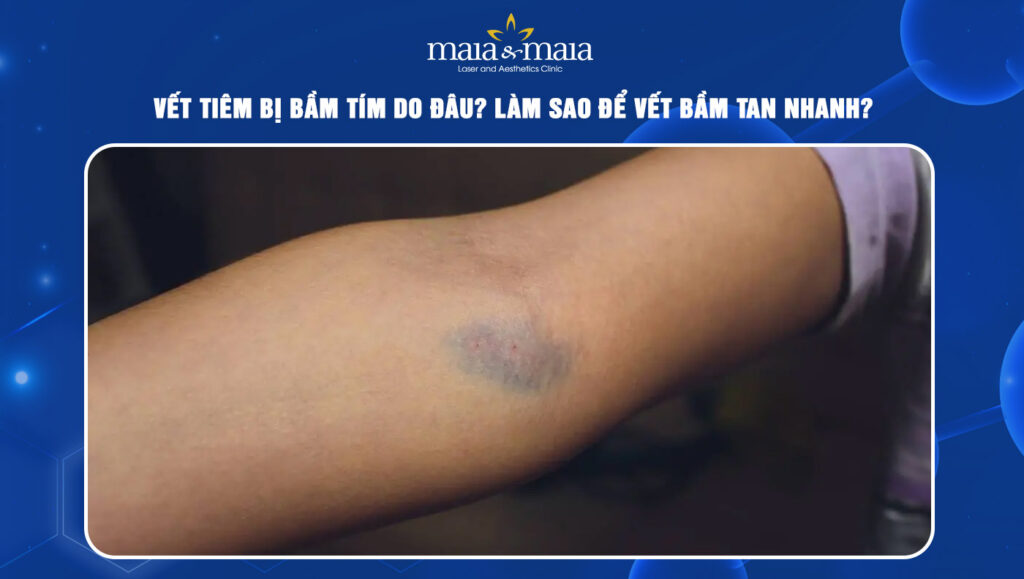 Vết tiêm bị bầm tím do đâu? Làm sao để vết bầm tan nhanh? 1 Vết tiêm bị bầm tím