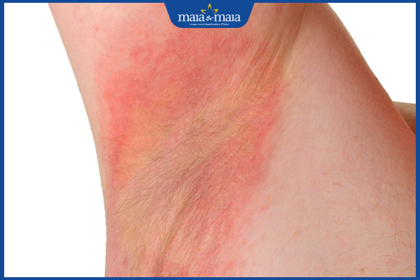 Peel da trị thâm nách có an toàn không? Lưu ý khi thực hiện 5 vùng nách kích ứng