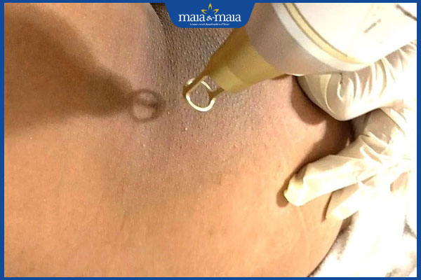 xóa thâm mông bằng laser