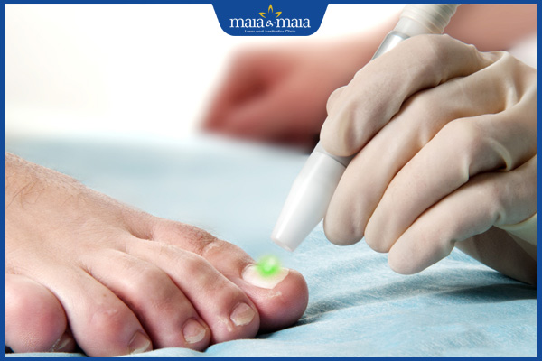 bắn laser nấm móng