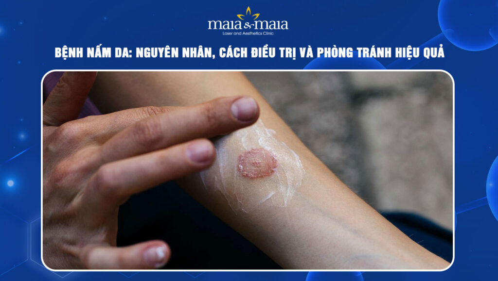 Bệnh nấm da: Nguyên nhân, cách điều trị và phòng tránh 1 Bệnh nấm da