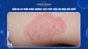 Nấm da có chữa được không
