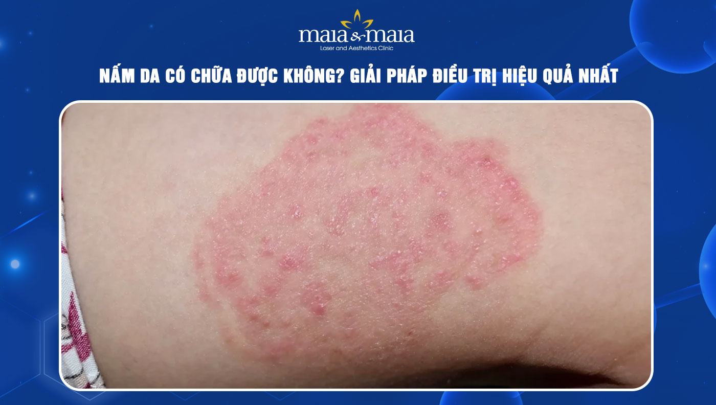 Nấm da có chữa được không