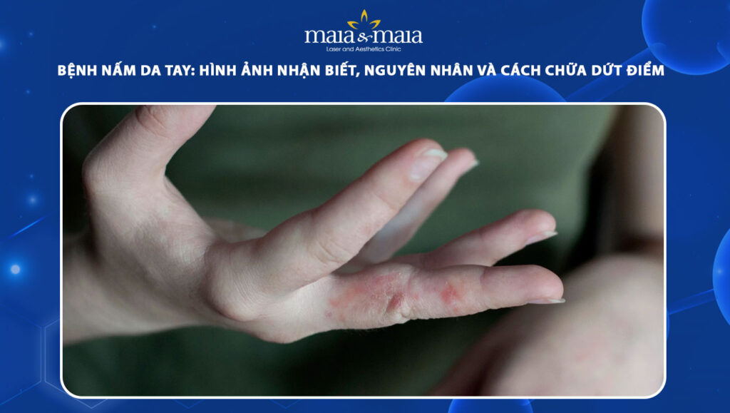 Bệnh nấm da tay: Nhận biết, nguyên nhân và cách điều trị 1 bệnh nấm da tay