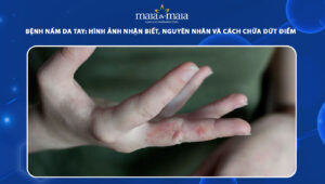 bệnh nấm da tay