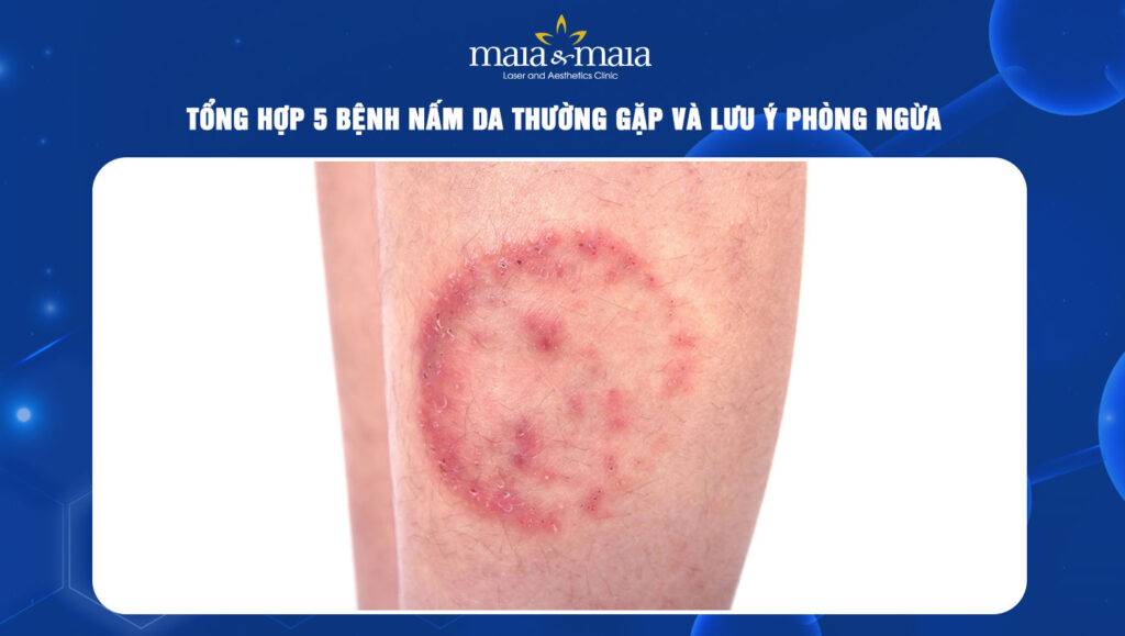 bệnh nấm da thường gặp