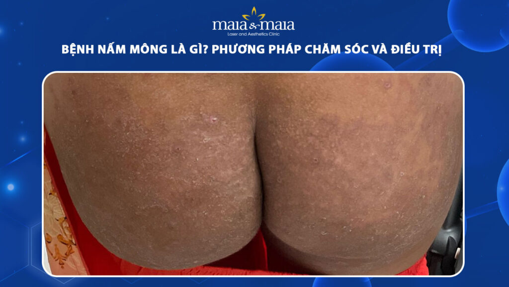 bệnh nấm mông
