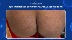 bệnh nấm mông