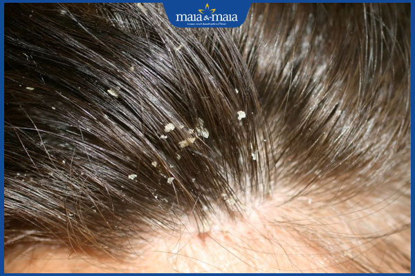 Nấm da không ngứa là bệnh gì? Nên làm gì để phòng ngừa? 4 bị nấm da đầu