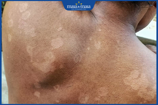 Nấm da không ngứa là bệnh gì? Nên làm gì để phòng ngừa? 2 bị nấm da không ngứa